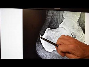 WHEN AND WHEN NOT TO DO POSTERIOR HEEL SPUR MINIMALLY INVASIVE