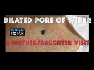 A giant blackhead extracted in an 85 y.o accompanied by her daughter. Most Favorite Videos: 1. Amateur home Pimple Popping & Blackheads Removing #pimple #blackhead @ https://fb.com/362614867918349 2. Top 5 Blackheads Removing Satisfying Compilation 2019 - EP5 - Blackheads and whiteheads removal 2019 @ https://fb.com/2263786033889389 3. Pimple Popping & Blackheads Removing 2019 - Compilation #BLACKHEADS @ https://fb.com/2201698553414931 4. Removal Large pimple on the right cheek.. Maybe even a Di