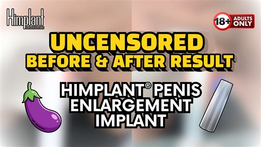 Before & After Penis Enlargement with HIMPLANT® FDA-Cleared Cosmetic Male Enhancement (Explicit)