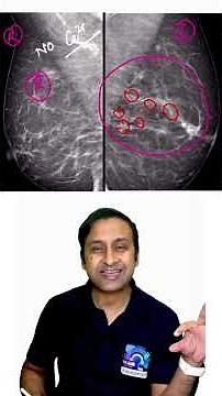 Suspicious Calcifications in Mammogram #breastcancer #breastradiology #Mammogram #radiobytes