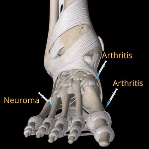 Ultrasound Guided Steroid Injections for Feet at our World-Class Clinic