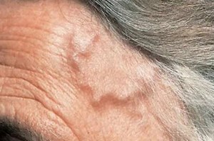 Arterite di Horton: sintomi, diagnosi e cura di questa vasculite