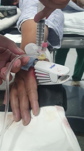 Induction via Propofol during General Anesthesia #medicalshorts #foryou