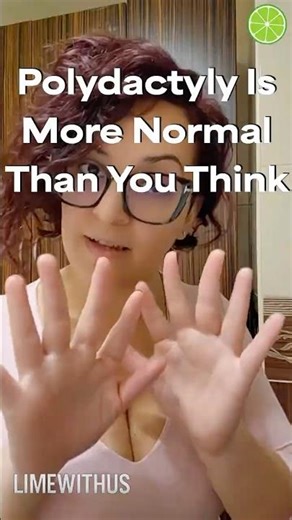 Polydactyly Is More Normal Than You Think