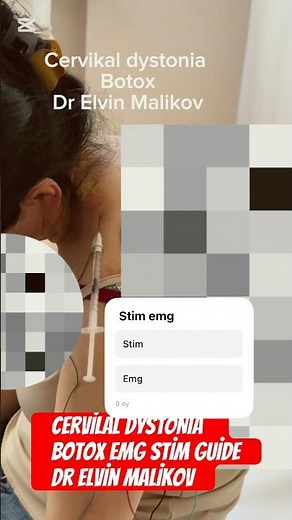 Cervikal dystonia botox emg stim guide with dr Elvin Malikov