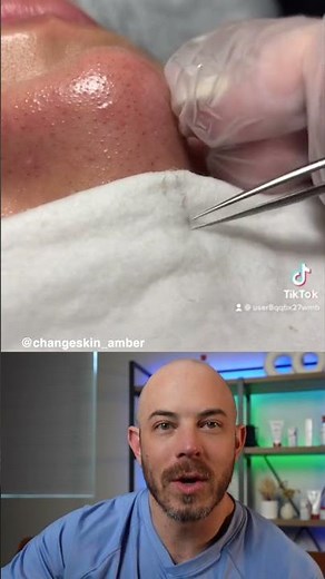 Dermatologist reacts to super satisfying clogged pore removal! #cloggedpores #dermreacts