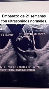 Cerclaje cervical de emergencia. Embarazo de 21 semanas con protusion de membranas. #embarazo #bebes #embarazada #embarazosaludable #cerclaje #cerclajecervical #cirugia #quirofano | Dr. Rodrigo Escalante.