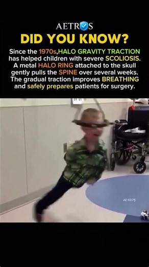 The Halo Device That Helps Straighten the Spine #history #facts