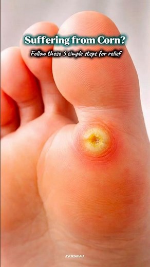 Remove Corn Naturally — 5 Daily Steps for Healthy Feet and get rid of Corn | How to prevent corn |
