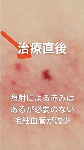 【老人性血管腫】症例編 Vビーム 赤いホクロ #Shorts