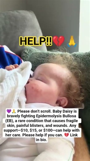 Every second counts. Please help Baby Daisy battle EB. A $20 or $50 donation helps