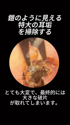 #earwax #earcleaning #asmr #satisfyingvideo #earwaxremoval #satisfying