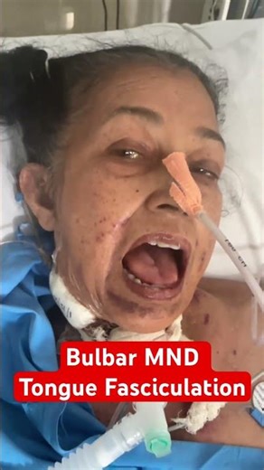 Bulbar MND - Motor neurone disease | Tongue atrophy and Fasciculations #motorneuronedisease