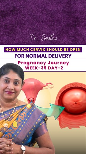 Dr Savitha Ashok on Instagram: "How much cervix dilation is needed for normal delivery? 🤔👶 During labor, your cervix slowly opens to help baby move out. Normal delivery usually happens when cervix reaches 10 cm dilation ✅ Cervical dilation stages: 1️⃣ Early labor: 1–4 cm 2️⃣ Active labor: 4–7 cm 3️⃣ Transition: 7–10 cm (intense stage) Once you’re 10 cm, baby is ready to come into the world 🌍💛 . . . . . . . . #CervicalDilation #NormalDelivery #LabourProcess #PregnancyEducation #BirthPreparati
