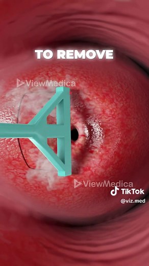 What is LEEP and why is it important? #leep #cervix #cervicalcancer #womenshealth #3dmedicalanimation #medicaleducation #3danimationsurgery