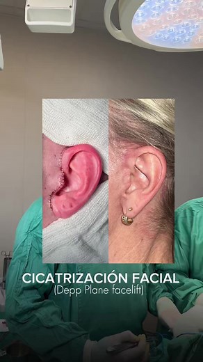 Lo que nadie te dice sobre la cicatrización después de un lifting facial 👀 Te mostramos el proceso en tiempo real: cómo evoluciona la piel, cuánto tiempo tarda en cicatrizar y cuándo las cicatrices comienzan a cerrarse de forma natural!! Quieres saber más? Déjanos tu comentario……… #lifting #latinoamerica #usa #paratiiiiiiiiiiiiiiiiiiiiiiiiiiiiiii #fyp
