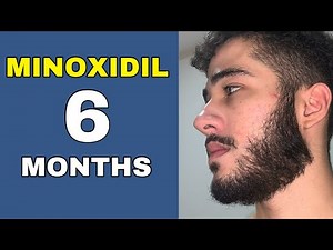 Minoxidil Beard Journey 6 MONTHS TRANSFORMATION