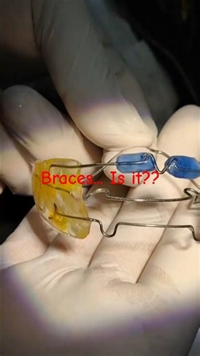 “Frankel Appliance: Gentle guidance for natural jaw growth.”#teeth #braces #fyp #dentist #sitamarhi