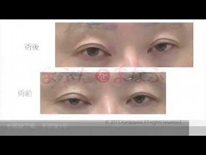 Horner症候群（ホルネル症候群）による右眼瞼下垂の手術をして1年経過
