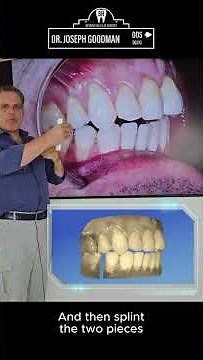 Revolutionary No Surgery Open-Bite Correction with Class One Veneers | Dr. Joseph Goodman