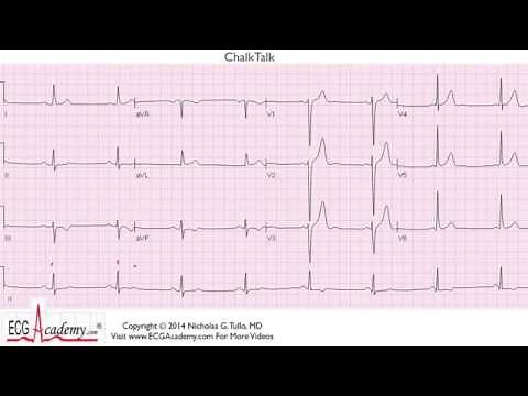 ECG Interpretation Tutorial - ChalkTalk 145 - Advanced Level
