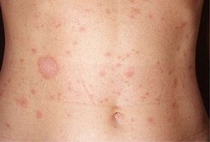 Pitiriasis Rosada - Diagnóstico Y Cuidado | Dermitek