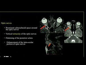TMT: CSF FLOW PART III: SPONTANEOUS INTRA CRANIAL HYPERTENSION
