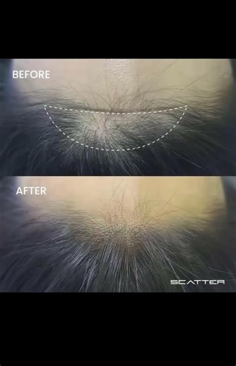 Demonstration of the procedure and before-and-after results for three key areas in woman