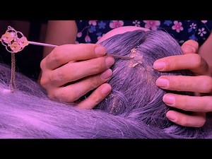 ASMR Dandruff Scratching🤩, Dandruff Removal🤯 & Tingly Scalp Check & Relaxing Crispy Sounds(2 ver)