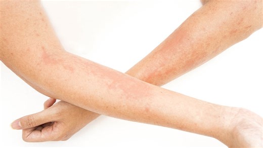 Understanding Atopic Dermatitis