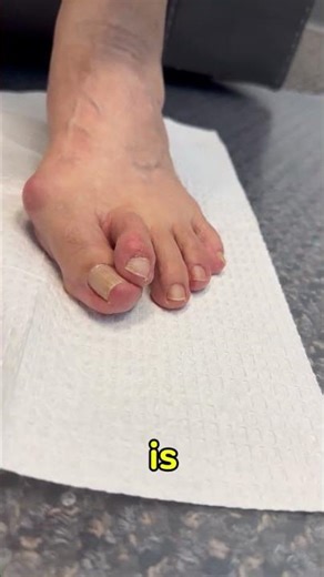 PART 1: Treating a Bunion and Crossover Toe