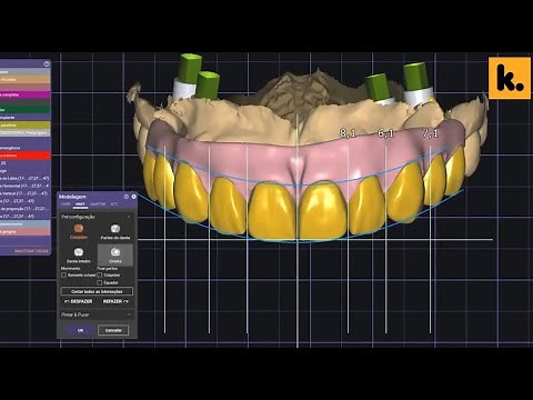 All on Four - Implant Bridge design with Exocad 3.0 | 3Shape TRIOS | Vladyslav Pereverzyev
