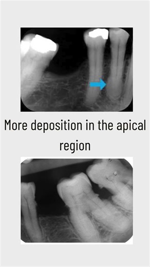 Does Cementum Increase With Age? #dentist #periodontology #shorts