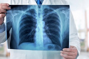 Pulmonary vasculitis: what it is, causes and symptoms