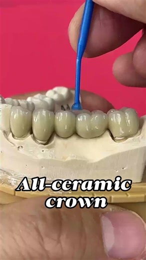Crown & Bridge vs. Veneers: Dental Solutions Explained
