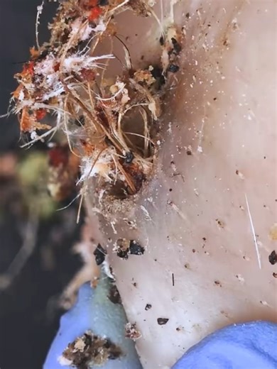 ASMR Zit Popping with Dr Lee's Ultimate Tweezer