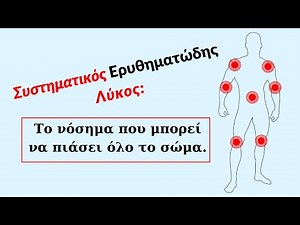 Συστηματικός Ερυθηματώδης Λύκος: Συμπτώματα και διάγνωση
