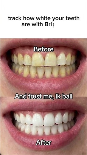 get your teeth score with the “Brighter Teeth” app