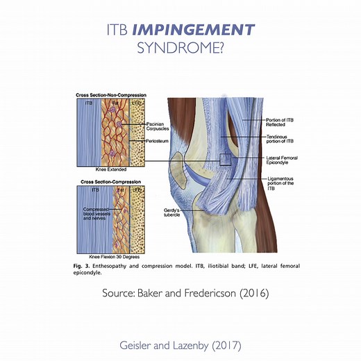 Does friction cause pain in the ITB? Or is there another reason the ITB becomes painful? Find out in this video with Tom Goom (Running Physio). Free ITB assessment & treatment videos at https://www.clinicaledge.co/itbfreevideos | Clinical Edge