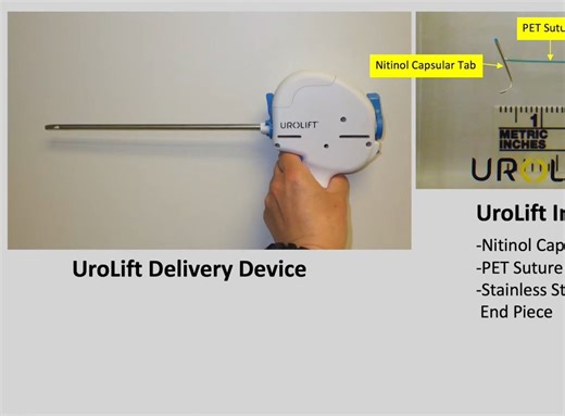 经尿道前列腺悬扩术 Urolift 超详细介绍 [机翻字幕]