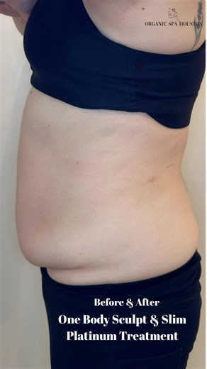 ✨ BEFORE ➡️ AFTER: ONE BODY SCULPT & SLIM PLATINUM + SKIN TIGHTENING + DETOX + FAT LOSS TREATMENT ✨