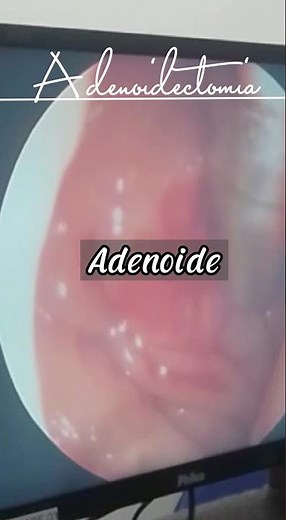 Cirurgia de retirada da adenoide