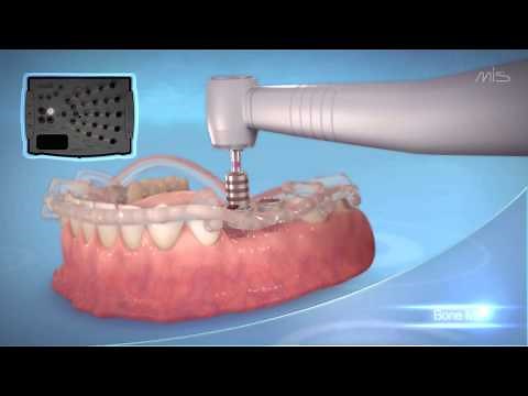 MIS Implants MGUIDE- guided Implant placement procedure