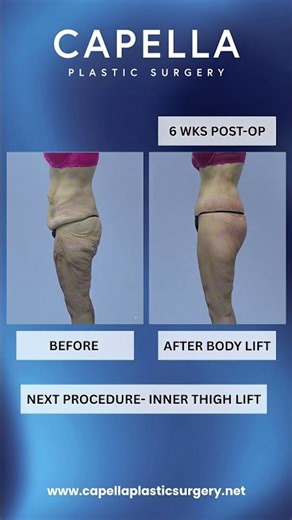 ✨ PART 3: Body Lift After 146-Lb Weight Loss — What Comes Next? ✨