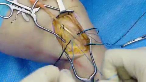 In today's #WhatsNewAtArthrex, Neal ElAttrache, MD, demonstrates an MCL reconstruction using a gracilis tendon autograft and the InternalBrace™ technique. Dr. ElAttrache also provides surgical pearls for anchor placement and incorporation of the InternalBrace technique.Learn more: https://t.co/WnQ4Kha4mpThe InternalBrace surgical technique is intended only to augment the primary repair/reconstruction by expanding the area of tissue approximation during the healing period and is not intended as a