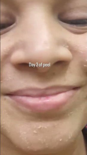 My acne peel journey. #skincare #trendingvideo #shortvideo #youtubeshorts #glowingskin