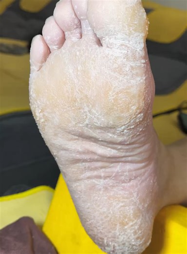 Heel Peeling for Callus Removal | Foot Care ASMR