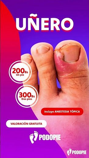 TRATAMIENTO DE UÑAS ENCARNADAS👣