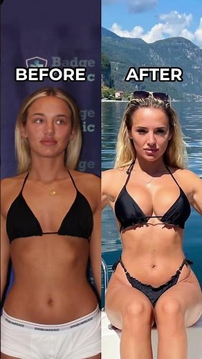 Breast Implants Before and After