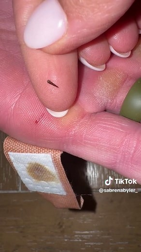 Effortless Splinter and Thorn Removal with PRID Drawing Salve